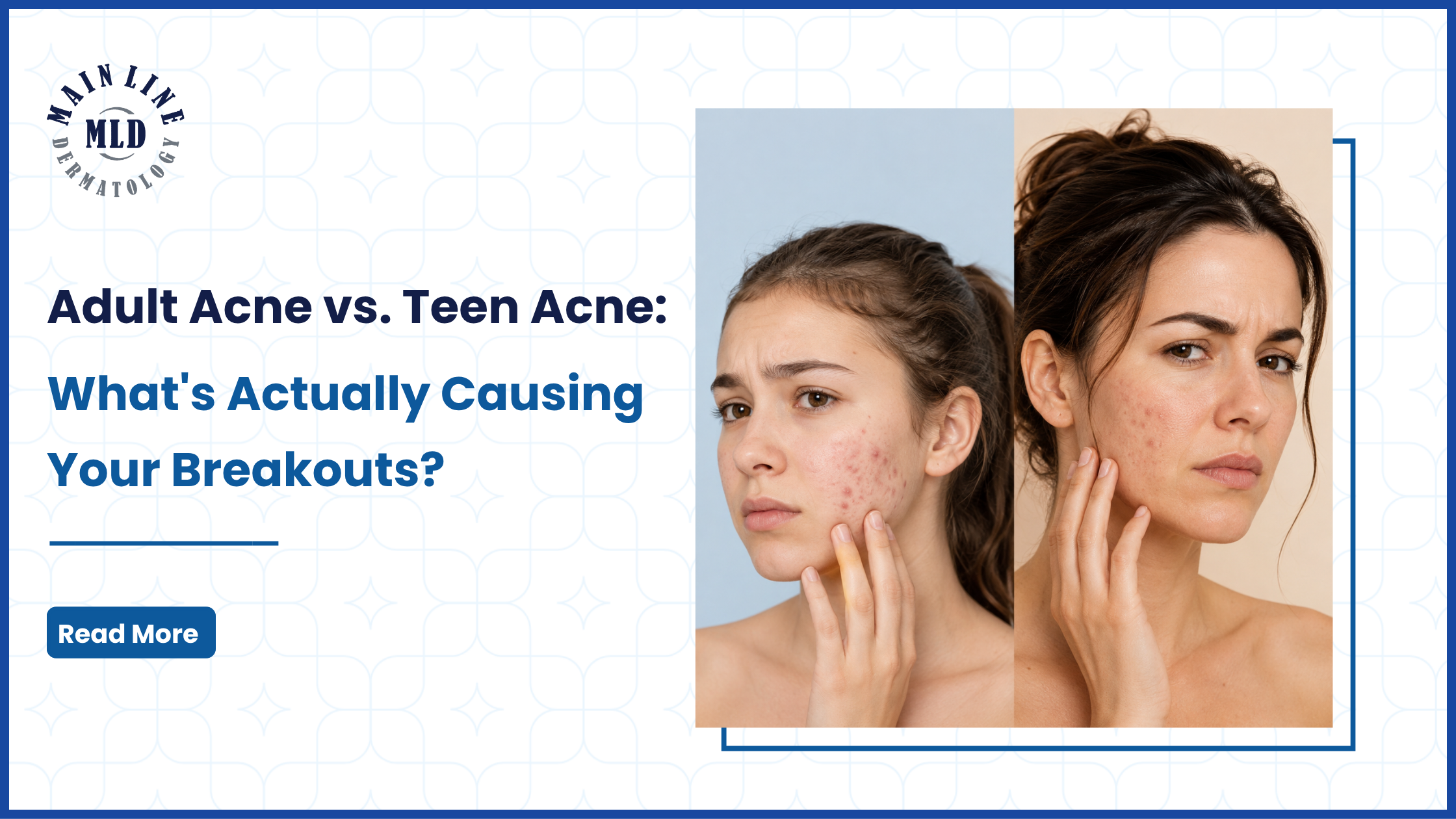 Adult Acne vs. Teen Acne 