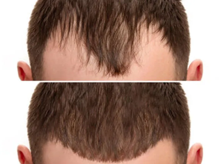 Hair transplant before and after: temple recession filled in for a more natural-looking hairline