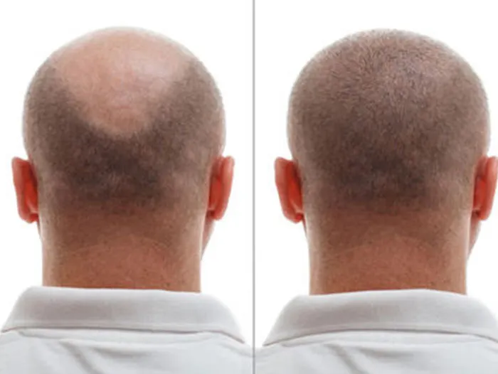 Hair transplant before and after: fuller coverage across a thinning crown