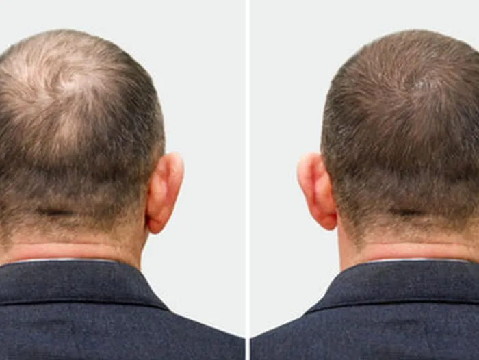 Hair transplant before and after: a lowered, denser hairline framing the forehead