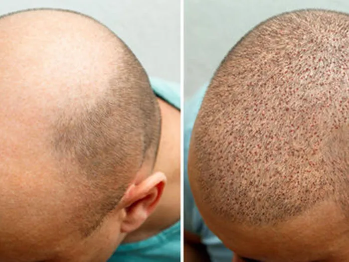 Hair transplant before and after: reduced scalp visibility with restored density on top