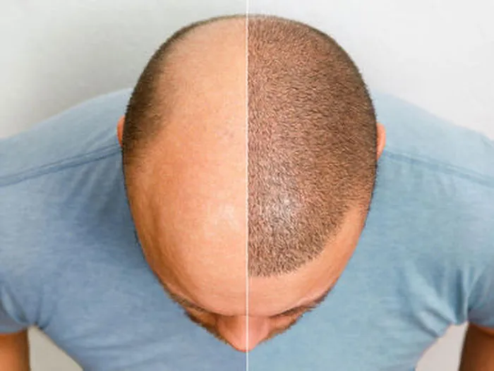 Hair transplant before and after: a receded frontal hairline rebuilt with denser coverage