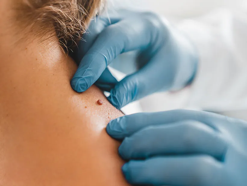 Dermatologist examining a patient's skin with a dermatoscope