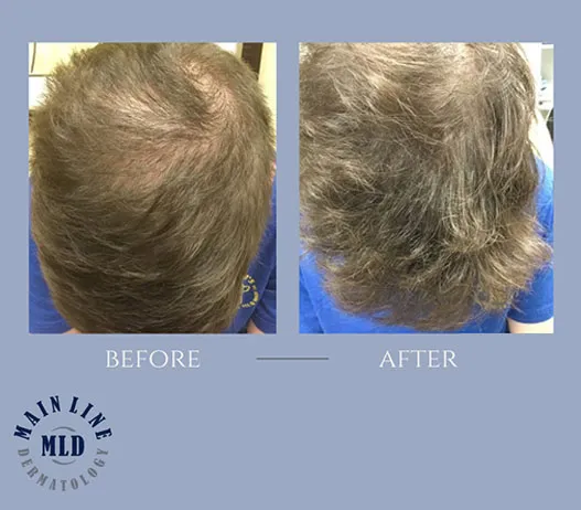 Crown before and after PRP therapy for hair loss: thinning at the vertex replaced by fuller coverage