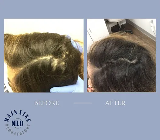 Part line before and after PRP therapy for hair loss: a widened part grown in along the scalp