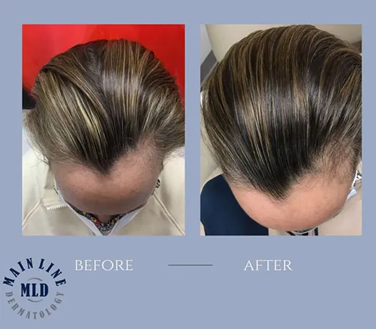 Frontal hairline and part before and after PRP therapy for hair loss: fuller coverage across the front of the scalp