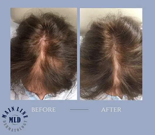 Crown and part before and after PRP therapy for hair loss: reduced scalp visibility along the part