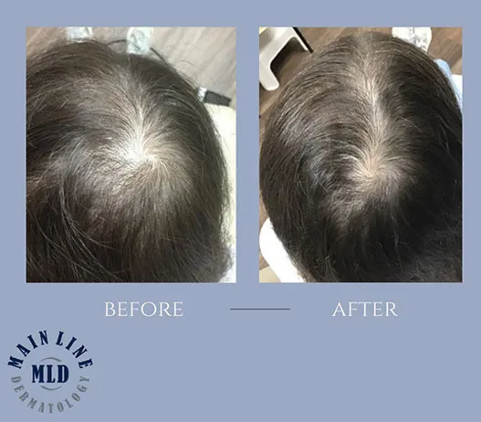 Vertex before and after PRP therapy for hair loss: denser hair across a thinning crown