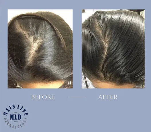 Part line before and after PRP therapy for hair loss: thicker hair reducing scalp show-through