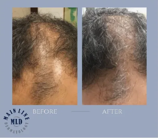 Crown before and after PRP therapy for hair loss: dense regrowth filling in a thinning vertex