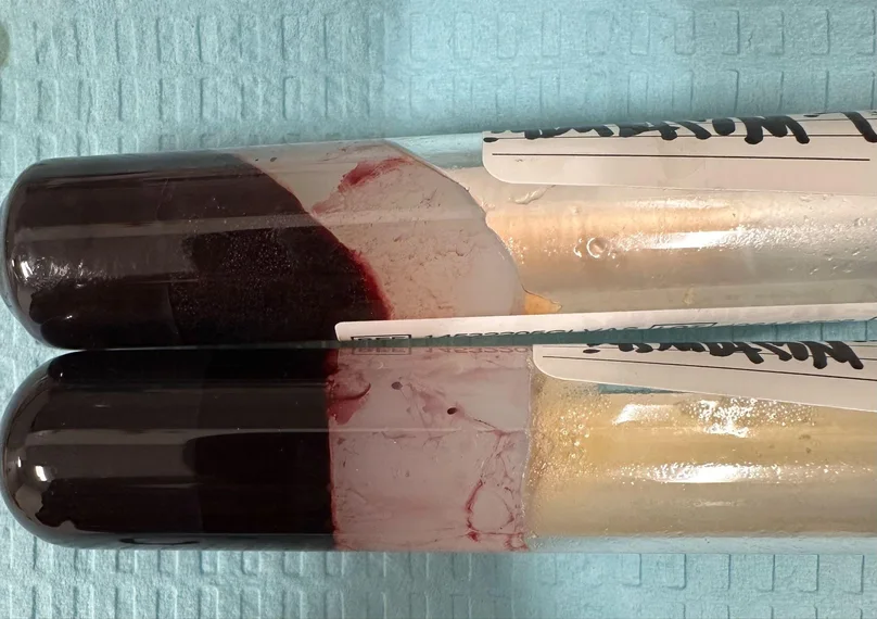Two centrifuged tubes showing the tight horizontal gel separation between the plasma and the red blood cells