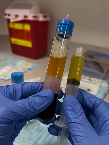 Two syringes of concentrated platelet-rich plasma prepared for injection