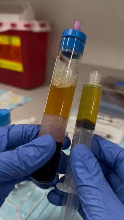 Two syringes of concentrated platelet-rich plasma prepared for injection