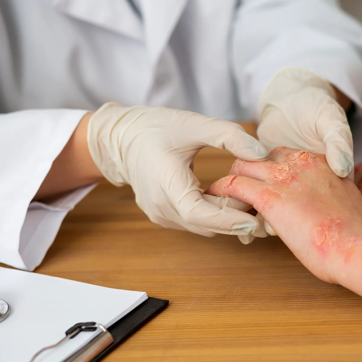 Dermatologist assessing raised, scaly psoriasis patches on a patient's elbow
