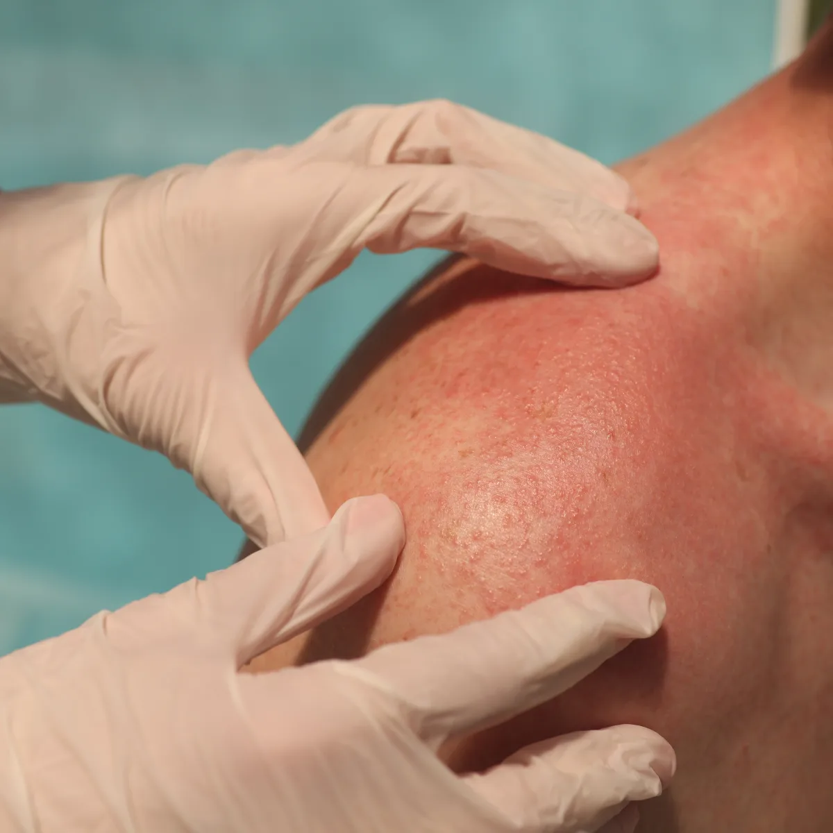 Dermatologist in gloves examining a red, inflamed rash on a patient&rsquo;s shoulder