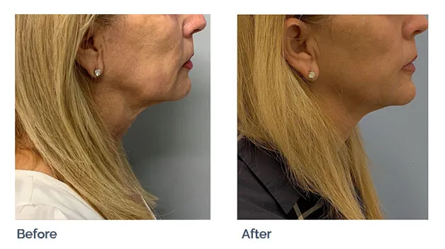 Sofwave skin tightening before and after: firmer jawline and neck contour