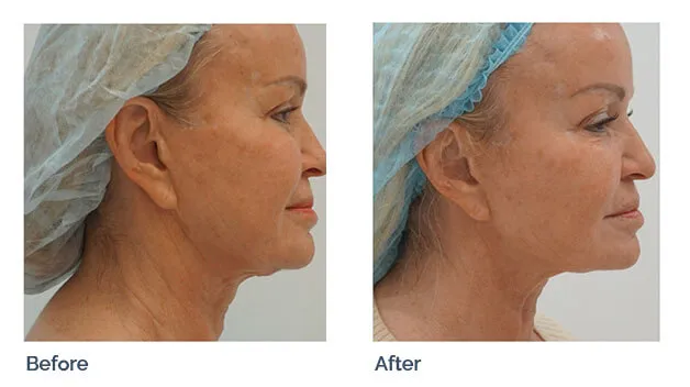 Sofwave skin tightening before and after: smoother neck and improved skin firmness