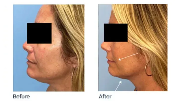 Sofwave skin tightening before and after: lifted jawline and reduced sagging under the chin