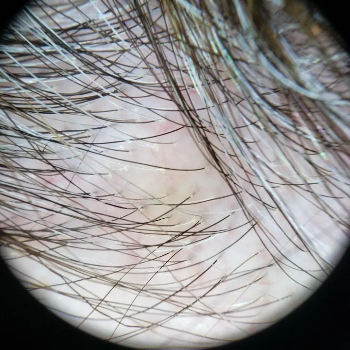 Trichoscopy view of the scalp showing hair follicles under dermatoscope magnification