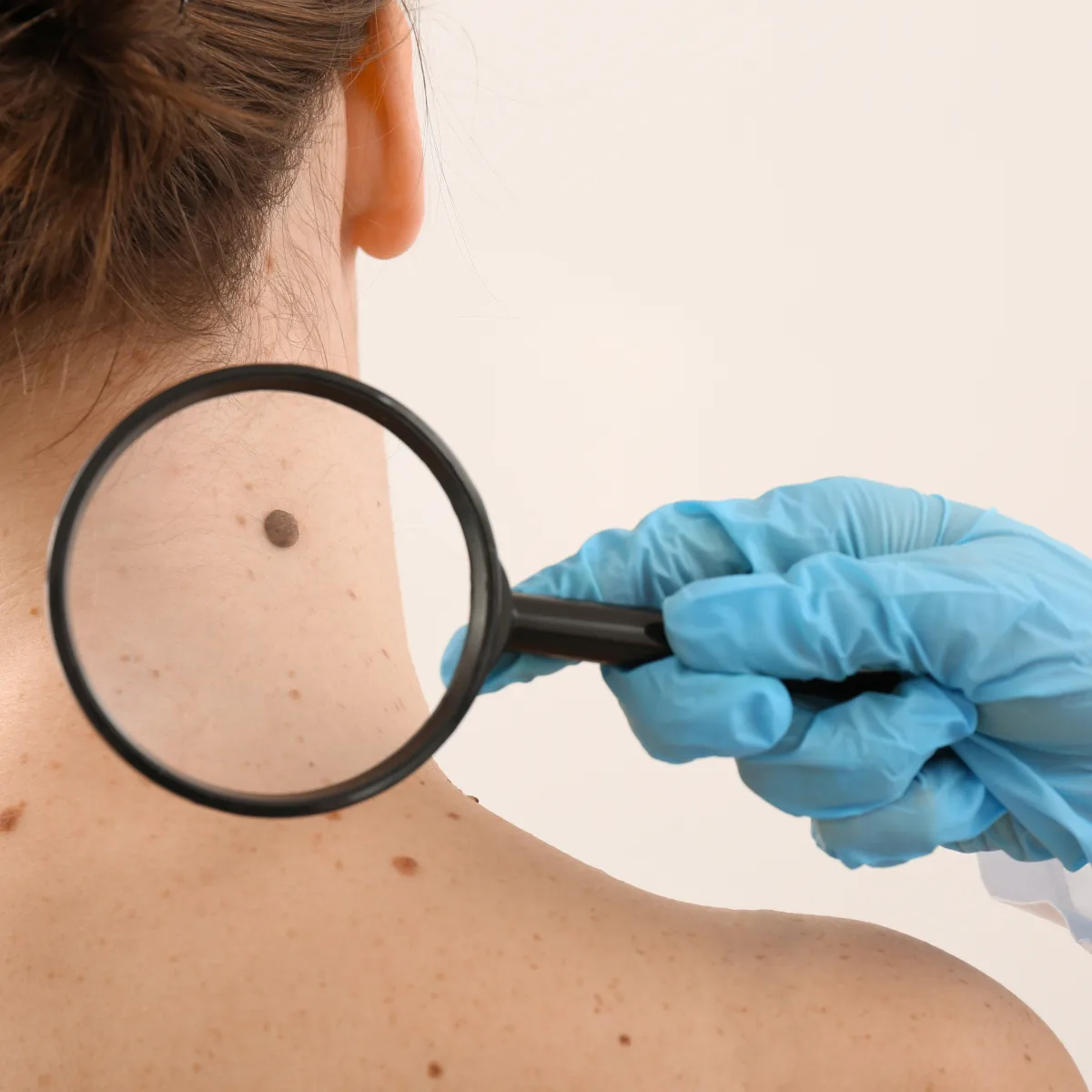 Dermatologist checking a mole on a patient's back with a magnifier