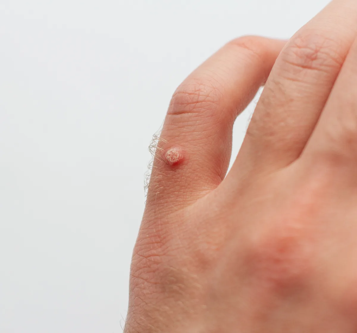 Close-up of a wart on the back of a patient&rsquo;s hand
