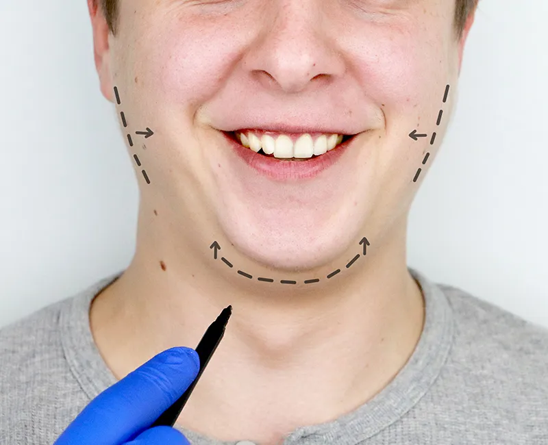 Chin Augmentation at Velora Face Clinic