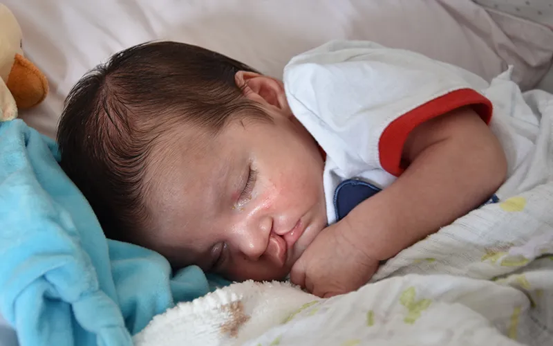Cleft Palate Surgery at Velora Face Clinic