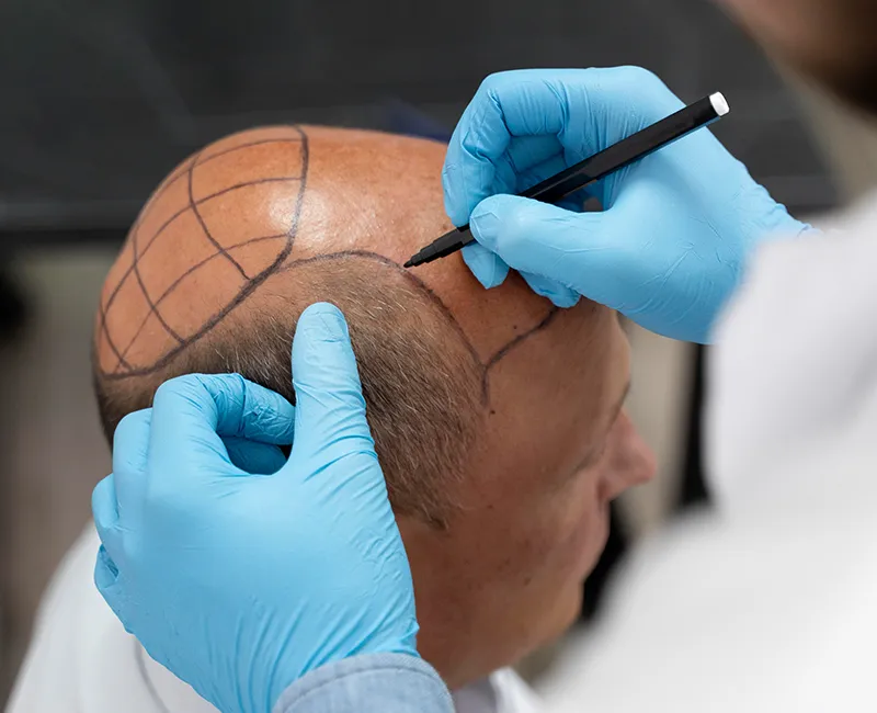 Hair Restoration at Velora Face Clinic