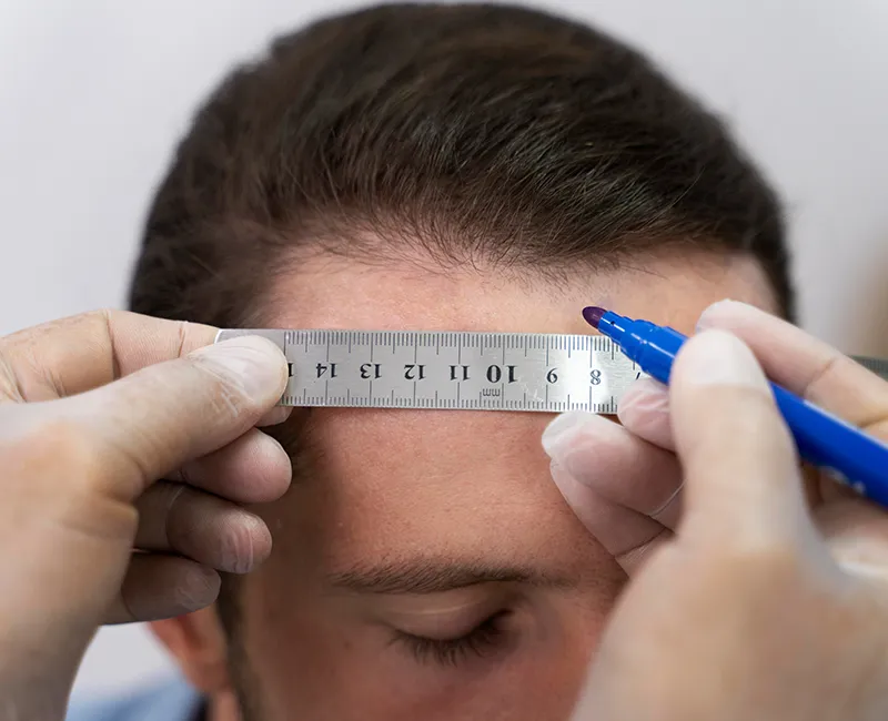 Hair Transplant at Velora Face Clinic