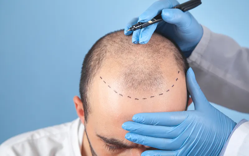 Hair Transplantation