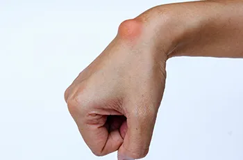 Ganglion Cysts