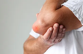 Olecranon Bursitis