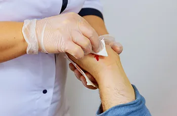 Compound (Open) Fractures