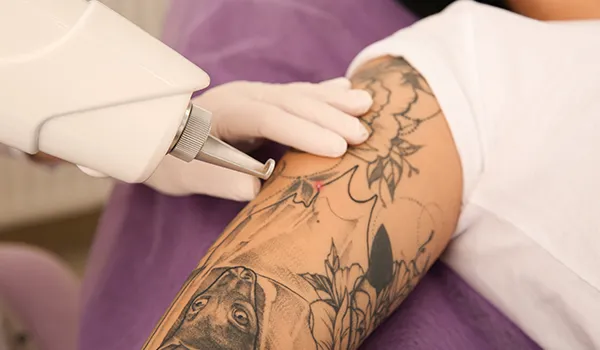 Who can Benefit from Pico Laser Tattoo Removal?