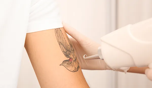 Quicker & More Effective Tattoo Removal with Pico Laser