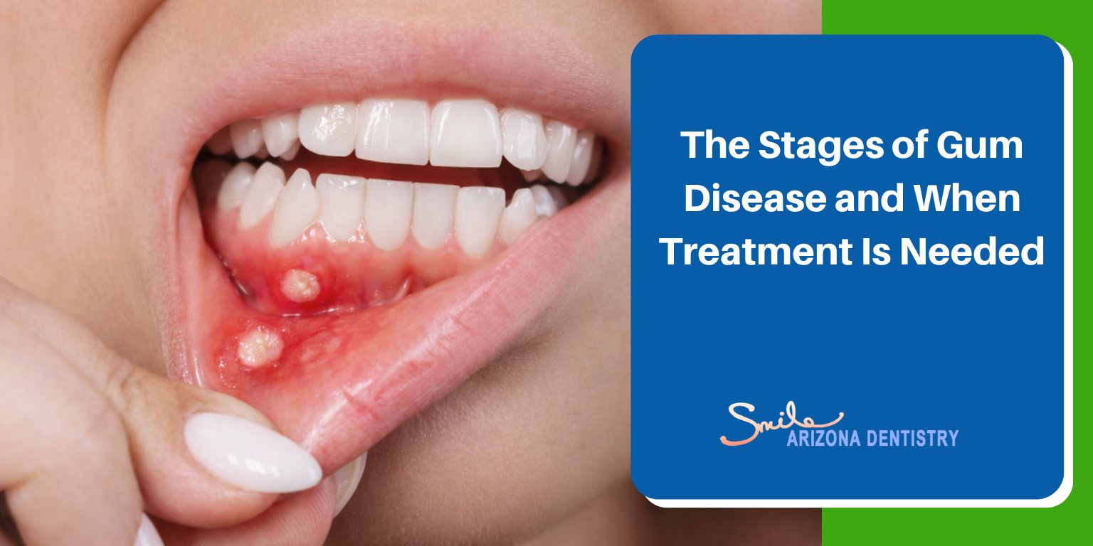 The Stages of Gum Disease and When Treatment Is Needed