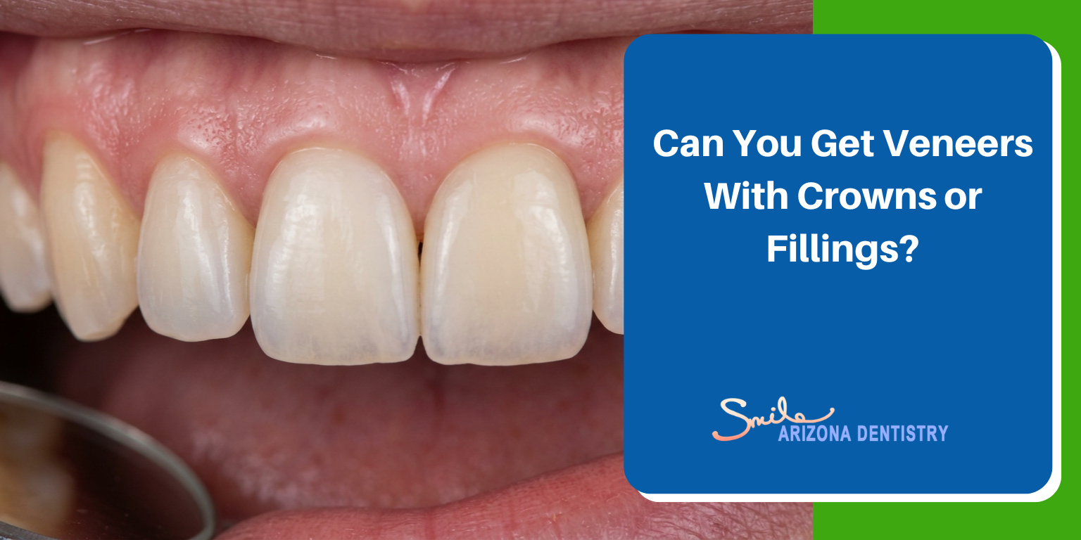 can you get veneers with crowns