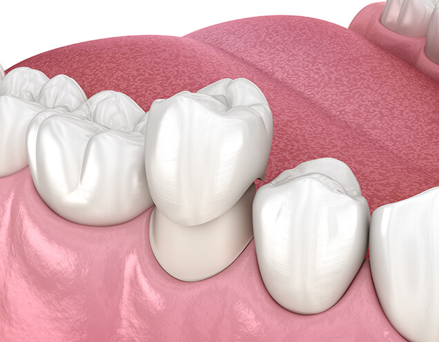 Protect Your Root-Canaled Tooth with Dental Crowns
