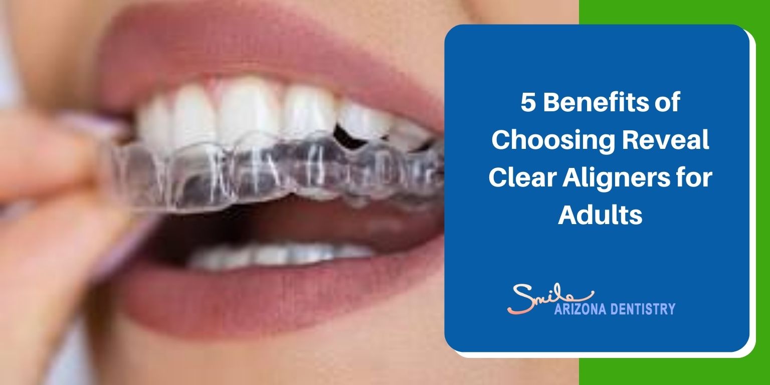 5 Benefits of Choosing Reveal Clear Aligners for Adults
