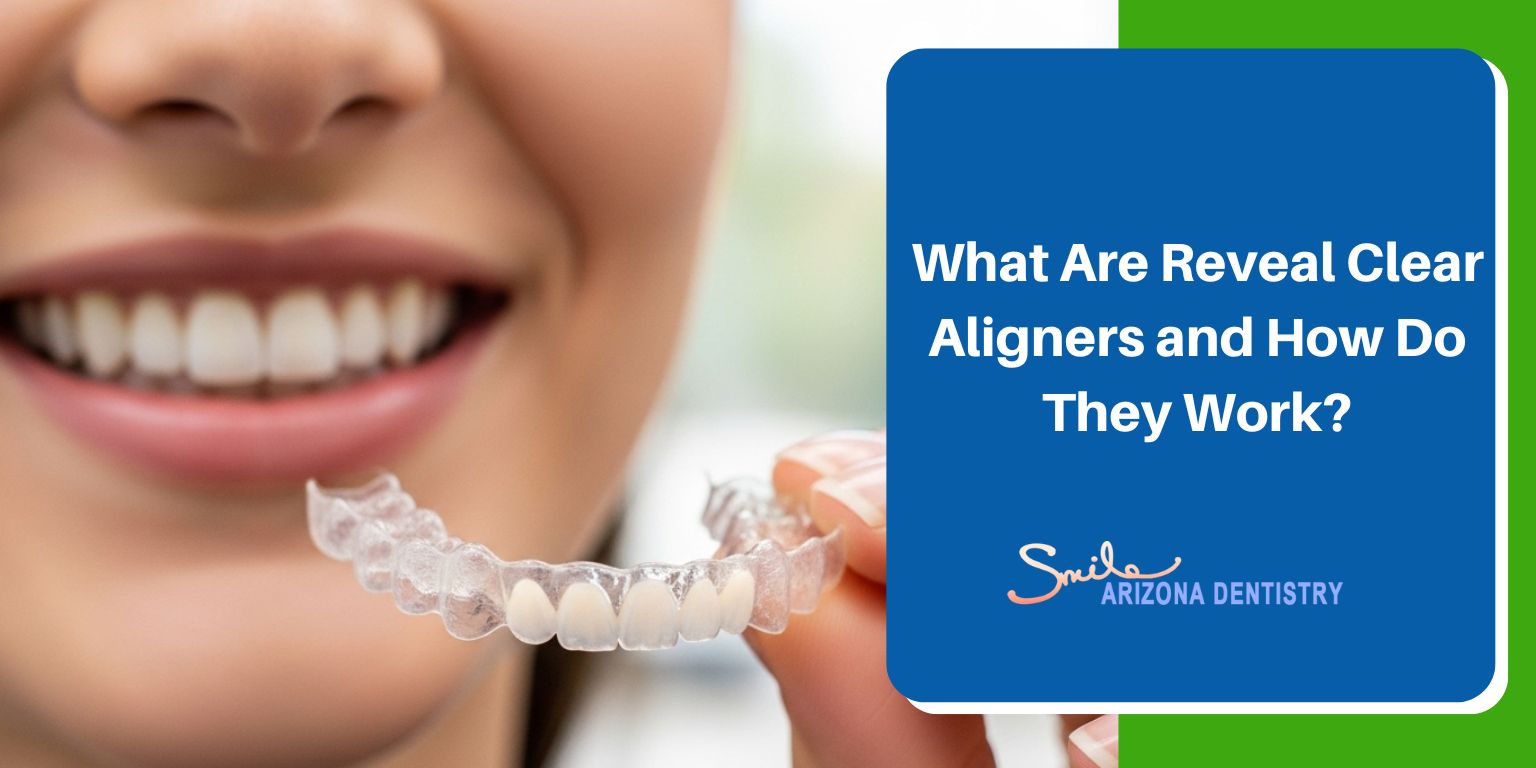 What Are Reveal Clear Aligners and How Do They Work?