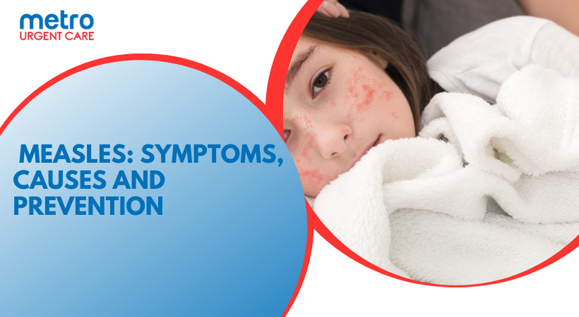  Measles: Symptoms, Causes and Prevention