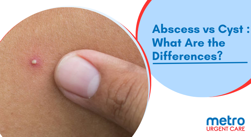 Abscess vs Cyst : What Are the Differences?