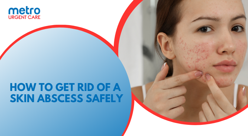 How to Get Rid of a Skin Abscess Safely