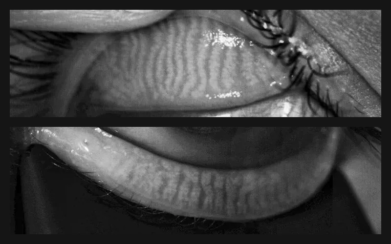 Dry Eye Lab