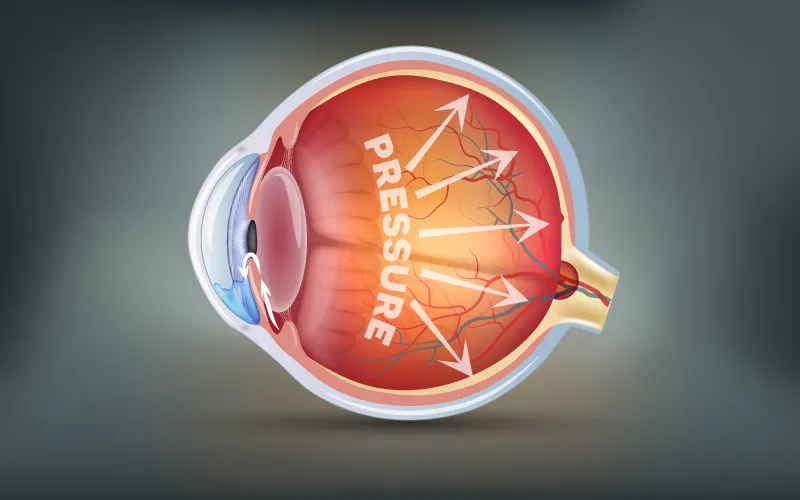 Glaucoma Treatment