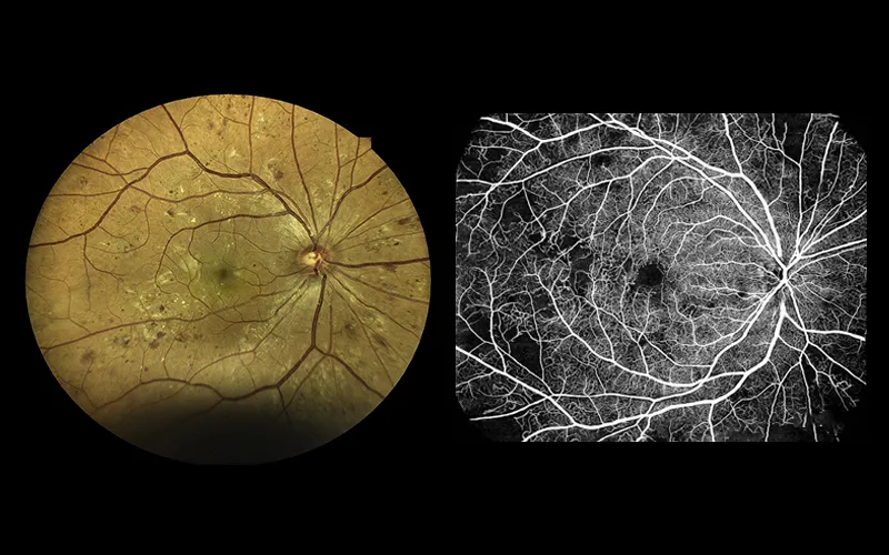 Glaucoma & Retina Clinics