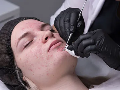 Acne Facial