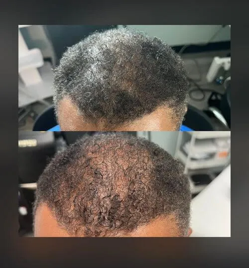 Hair Restoration Results