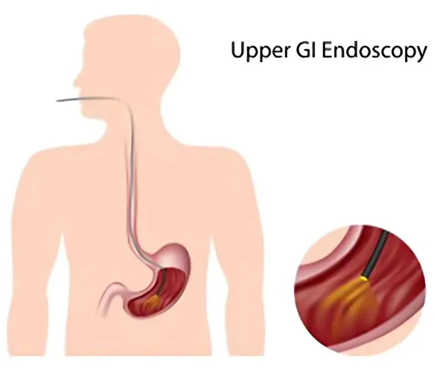 EGD-Esophagogastroduodenoscopy in Children
