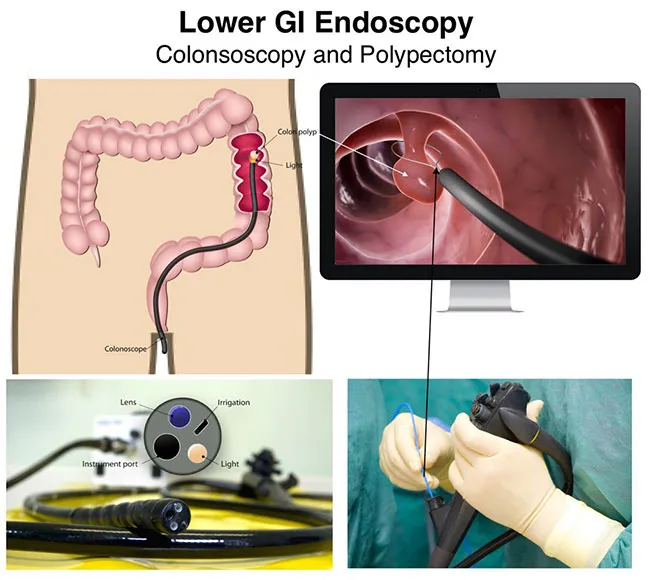 Colonoscopy in Children